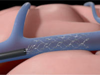 NeuroVasc secures US$34 million in funding to support clinical trials | Neurovascular Intervention | Scoop.it