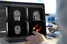 Cet algorithme est capable de prédire le risque de développer la maladie d'Alzheimer | Actualité sanitaire et sociale - CRDI Croix-Rouge Compétence                               Hauts-de-France | Scoop.it