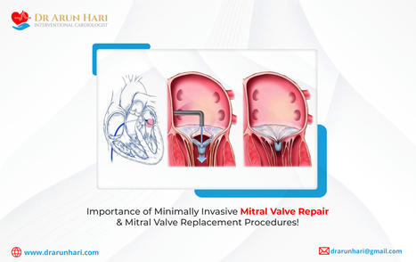 Importance of Minimally Invasive Mitral Valve R...
