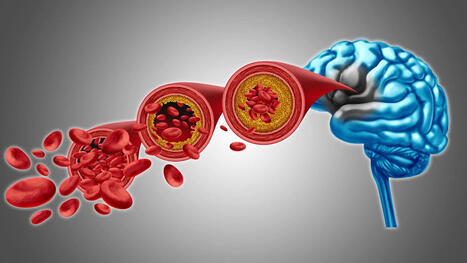 Scientists found a way to restore brain blood flow in dementia | Neurovascular Intervention | Scoop.it