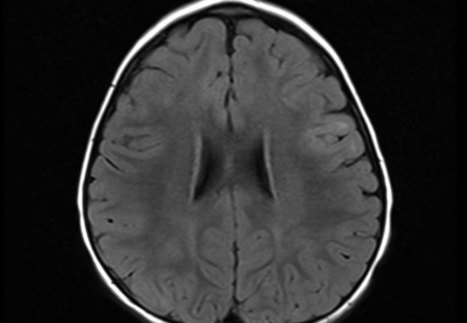 NMDAR Antibodies Guide Therapy for Encephalitis in a Young Child - Consult QD | AntiNMDA | Scoop.it