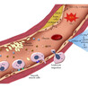 Peritoneal dialysis