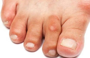 Toe Deformities: Mallet Toes and Claw Toes | Foot Doctor houston | Scoop.it