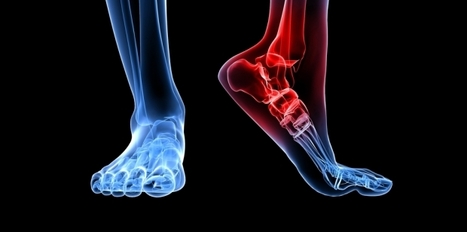 Nerve Injury Can Develop Before Diabetes | Neuropathy "The Painful Enigma" | Scoop.it