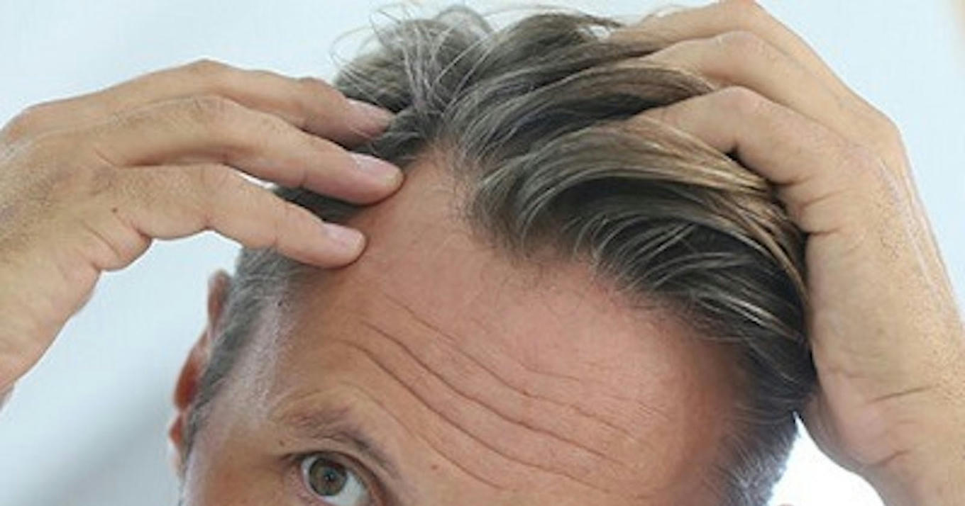 ACell PRP Therapy Transforming Hair Loss in Du...