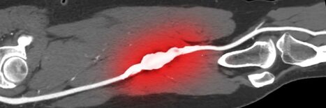Comparative effectiveness of endovascular treatment modalities for de novo femoropopliteal lesions at long-term follow-up | Critical Limb-Threatening Ischemia (CLTI) | Scoop.it