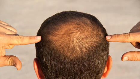 This Breakthrough Drug Wakes Up Sleepy Hair Follicles. It May Be the Ultimate Baldness Cure, Scientists Say. | The Health Report | Scoop.it