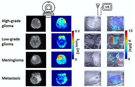 La physique des ondes sismiques pour un diagnostic des tumeurs cérébrales par élastographie IRM passive | Life Sciences Université Paris-Saclay | Scoop.it