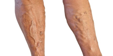 I've got varicose veins. What can I do about them? | Physical and Mental Health - Exercise, Fitness and Activity | Scoop.it
