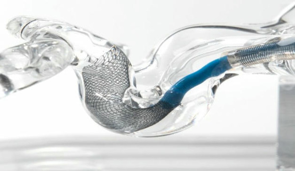 Anaconda Biomed receives IDE approval for enrollment in ATHENA study | Neurovascular Intervention | Scoop.it