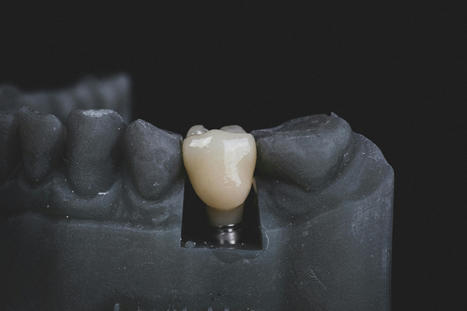 Navigating the World of Dental Implants: A Complete Overview for a Brighter Smile | Medical and Health | Scoop.it