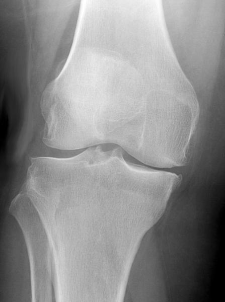 Characteristics and Effectiveness of Fall Prevention Programs in Nursing Homes: A Systematic Review and Meta-Analysis of Randomized Controlled Trials | Comprehensive Geriatric Assessment | Scoop.it