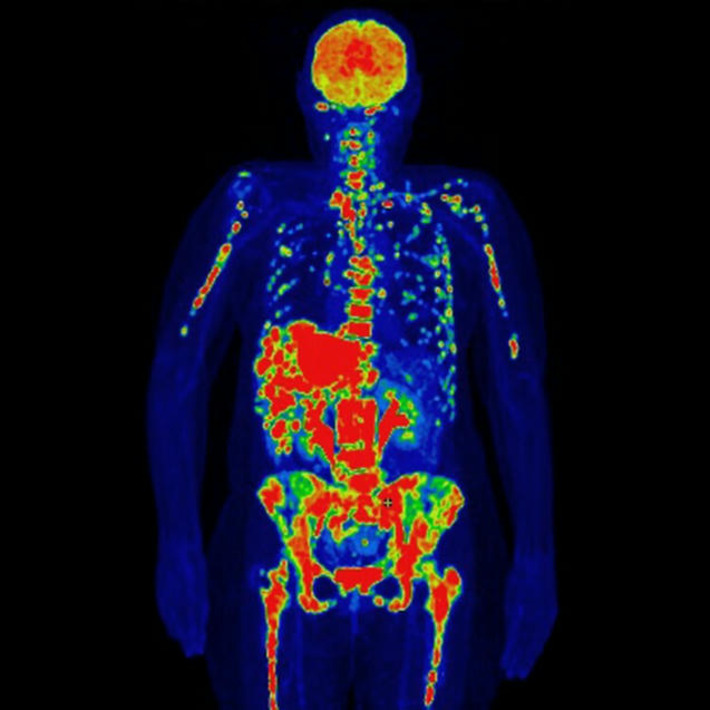 Why cancer rates are rising in young women—and what to do about it | The Health Report | Scoop.it