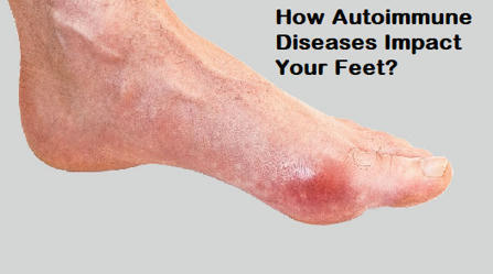 How Autoimmune Diseases Impact Your Feet? | Foot Doctor houston | Scoop.it