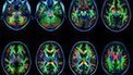 Web addicts 'have brain changes' | 21st Century Innovative Technologies and Developments as also discoveries, curiosity ( insolite)... | Scoop.it