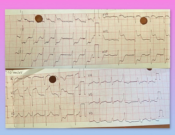 Acute ST elevation myocardial infarction in a young female patient without cardiovascular risk factors—Massive left main coronary artery thrombosis induced by oral contraceptive pills | Interventional Cardiology | Scoop.it