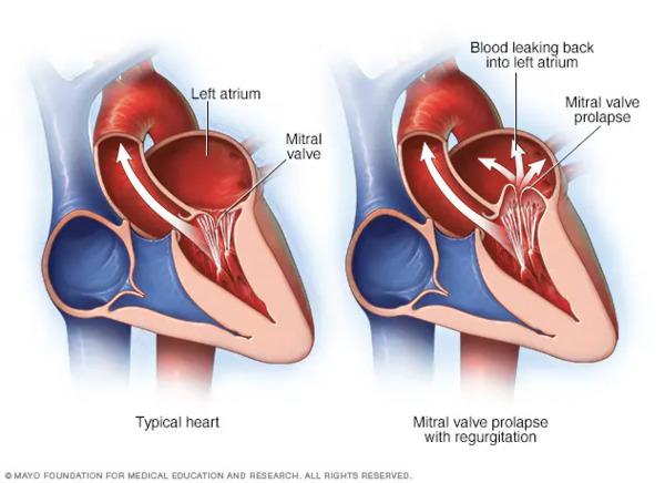 Trends in the Management of Anterior Mitral Leaflet Regurgitation | Transcatheter Treatment of Mitral Regurgitation | Scoop.it