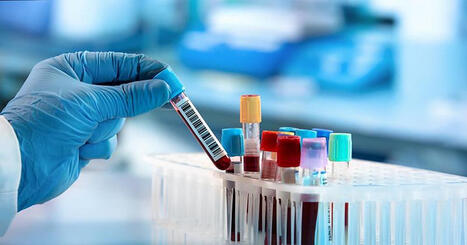 Un an&aacute;lisis de sangre com&uacute;n puede dar la pista sobre el riesgo de demencia futura | Alzheimer y m&aacute;s (Bolet&iacute;n n&ordm; 99) | Scoop.it