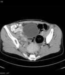 Mature (cystic) ovarian teratoma | Radiology Reference Article | Radiopaedia.org | AntiNMDA | Scoop.it