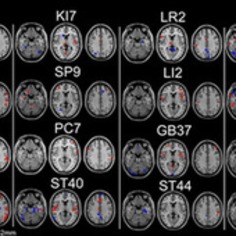 Proof That Acupuncture Really Does Activate Specific Parts of the Brain | Kinsanity | Scoop.it