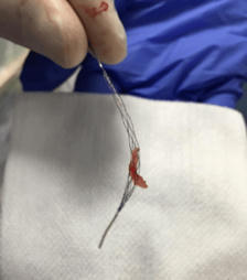 Rapid Medical’s Tigertriever XL receives CE mark approval | Neurovascular Intervention | Scoop.it