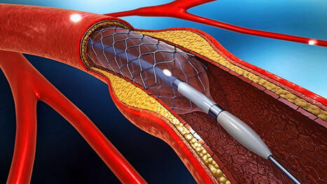 Two Major Trials Support Drug-Coated Balloons in PCI | Interventional Cardiology | Scoop.it