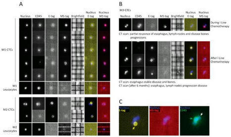 Cancers | Free Full-Text | CNA Profiling of Single CTCs in Locally Advanced Esophageal Cancer Patients during Therapy Highlights Unexplored Molecular Pathways | from Flow Cytometry to Cytomics | Scoop.it