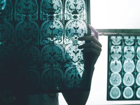 What causes Alzheimer's? Genes, environment and lifestyle play roles | Alzheimer y más (Boletín nº 69) | Scoop.it