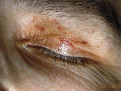 Skin manifestations of haematological diseases | DermNet | Systemic Mastocytosis, Tinnitus etc | Scoop.it
