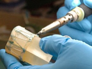 Get Ready for Catheter-Based Mitral Regurg Tx | Transcatheter Treatment of Mitral Regurgitation | Scoop.it