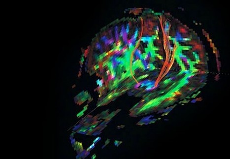 Therapeutics for Progressive Multiple Sclerosis: Where to Go from Here? | Multiple sclerosis | Scoop.it