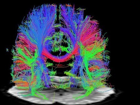 Scientists May Have Found A Way To Bring Back Memories Of Dementia Patients | Kinsanity | Scoop.it