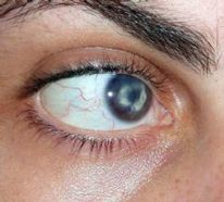 Queratitis por herpes simple: evitar la recurrencia | Salud Visual 2.0 | Scoop.it