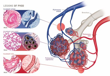 Similarités et différences entre maladie veino-occlusive hépatique et pulmonaire | Life Sciences Université Paris-Saclay | Scoop.it