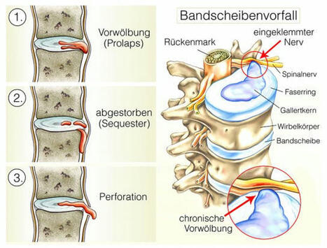 Inkontinenz durch Bandscheibenvorfall - KontinenzZentrum Hirslanden | 21st Century Innovative Technologies and Developments as also discoveries, curiosity ( insolite)... | Scoop.it