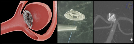 Endovascular treatment of wide-necked intracranial aneurysms using the Nautilus Intrasaccular System: initial case series of 41 patients at a single center | Neurovascular Intervention | Scoop.it