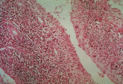 Granzyme - a major driver of inflammatory & autoimmune diseases | RheumNow | Rheumatology-Rhumatologie | Scoop.it
