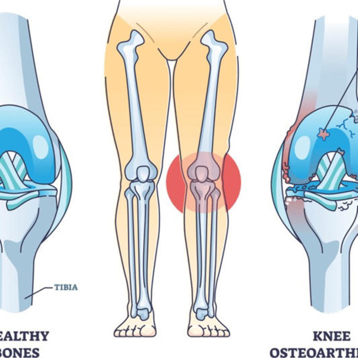 Osteoarthritis Symptoms: Early Warning Signs You Shouldn&rsquo;t Ignore | The Health Report | Scoop.it
