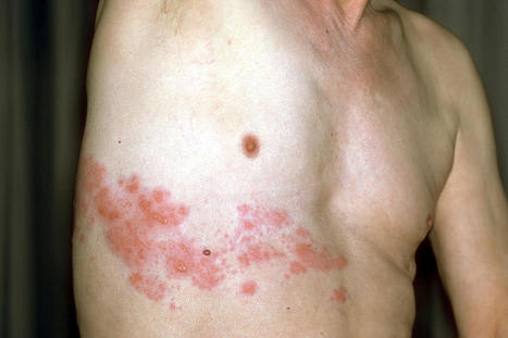 Herpes Infection Possibly Linked to COVID-19 Vaccine | Virus World | Scoop.it