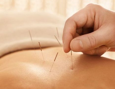 Acupuncture: What Is It and How Does It Work? | Common Medical Questions | Medical and Health | Scoop.it