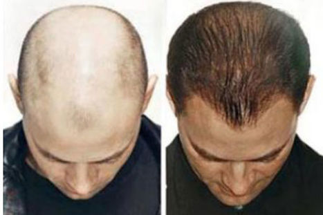 Tried And Tested Remedies To Stop Baldness And