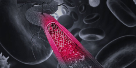 Fluid Biomed Inc. Announces World's First Implantation of Polymer-based Neurovascular Stent in Human Patients | Neurovascular Intervention | Scoop.it