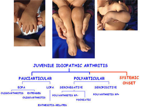 Autoimmunity Reviews - Systemic juvenile idiopathic arthritis - November 2012 | Immunology Diagnosis | Scoop.it