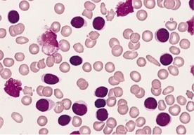 Vaccine-Produced Immune Cells May Be Associated with Leukeumia | Health Supreme | Scoop.it