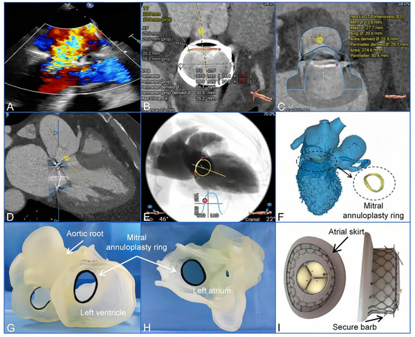 Combined Minimally Invasive Mitral Valve Surger...