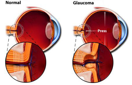 Retina Navarra inicia este lunes una campaña para prevenir el glaucoma | Salud Visual 2.0 | Scoop.it