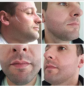 Beard Micropigmentation Clinic In The Uk Hair