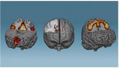 Santé Log : "Neurofeedback : "En un rien de temps, il peut changer le cerveau | Ce monde à inventer ! | Scoop.it