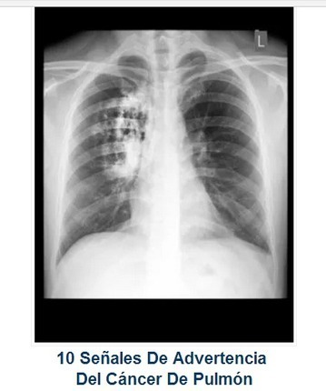 10 Señales De Advertencia Del Cáncer De Pulmón + 7 remedios naturales para ayudar en su tratamiento | PIENSA en VERDE | Scoop.it