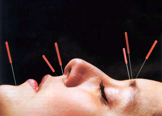 Have you tried acupuncture yet? | SELF HEALTH + HEALING | Scoop.it